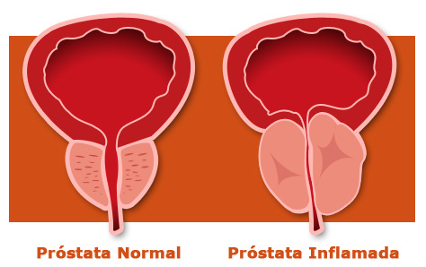 ¿Cuándo es el momento de operar la Hiperplasia Benigna de Próstata?